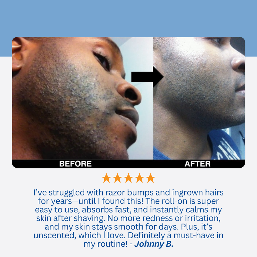 Razor Bump & Ingrown Hair Treatment