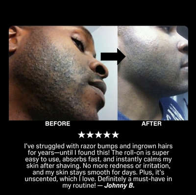 [THE INGROWN HAIR SOLUTION]