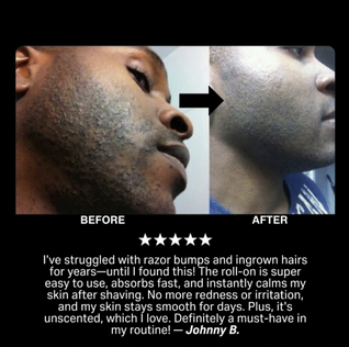 [THE INGROWN HAIR SOLUTION]