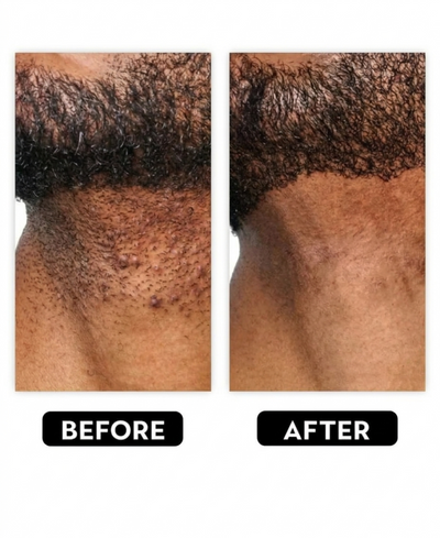 [THE INGROWN HAIR SOLUTION]